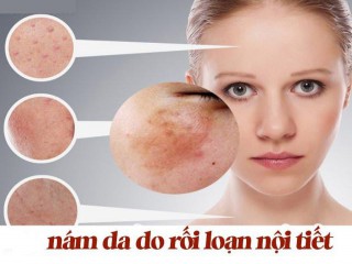 Phân biệt nám nội tiết tố và nám môi trường - đâu là giải pháp trị nám hiệu quả